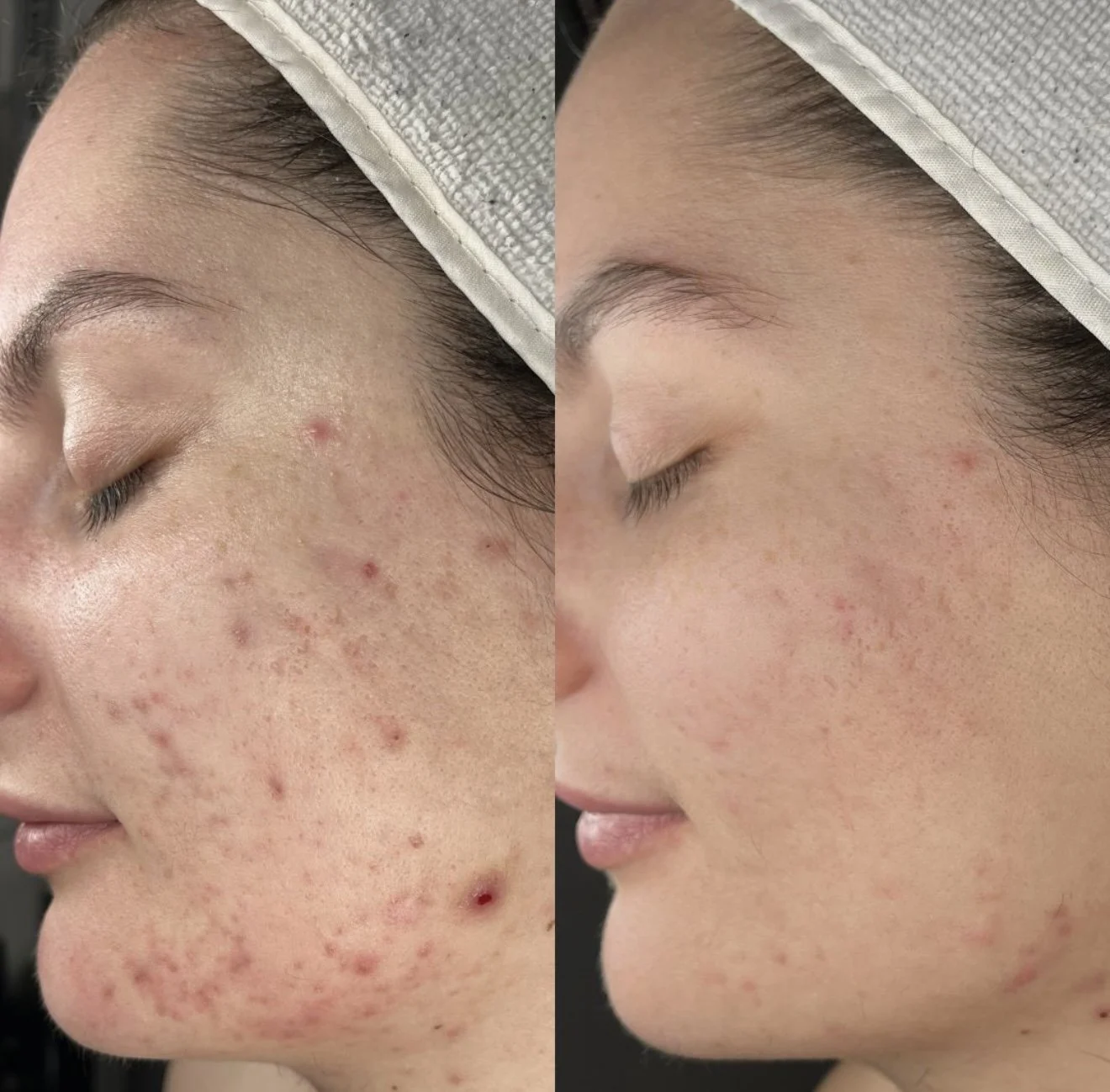 Close-up side view of a woman's face showing skin improvement from acne and blemishes to clearer skin.