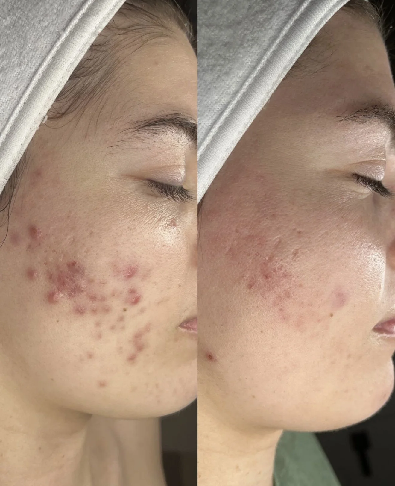Side-by-side comparison of a person's cheek before and after skin treatment, showing improvement in acne and skin texture.
