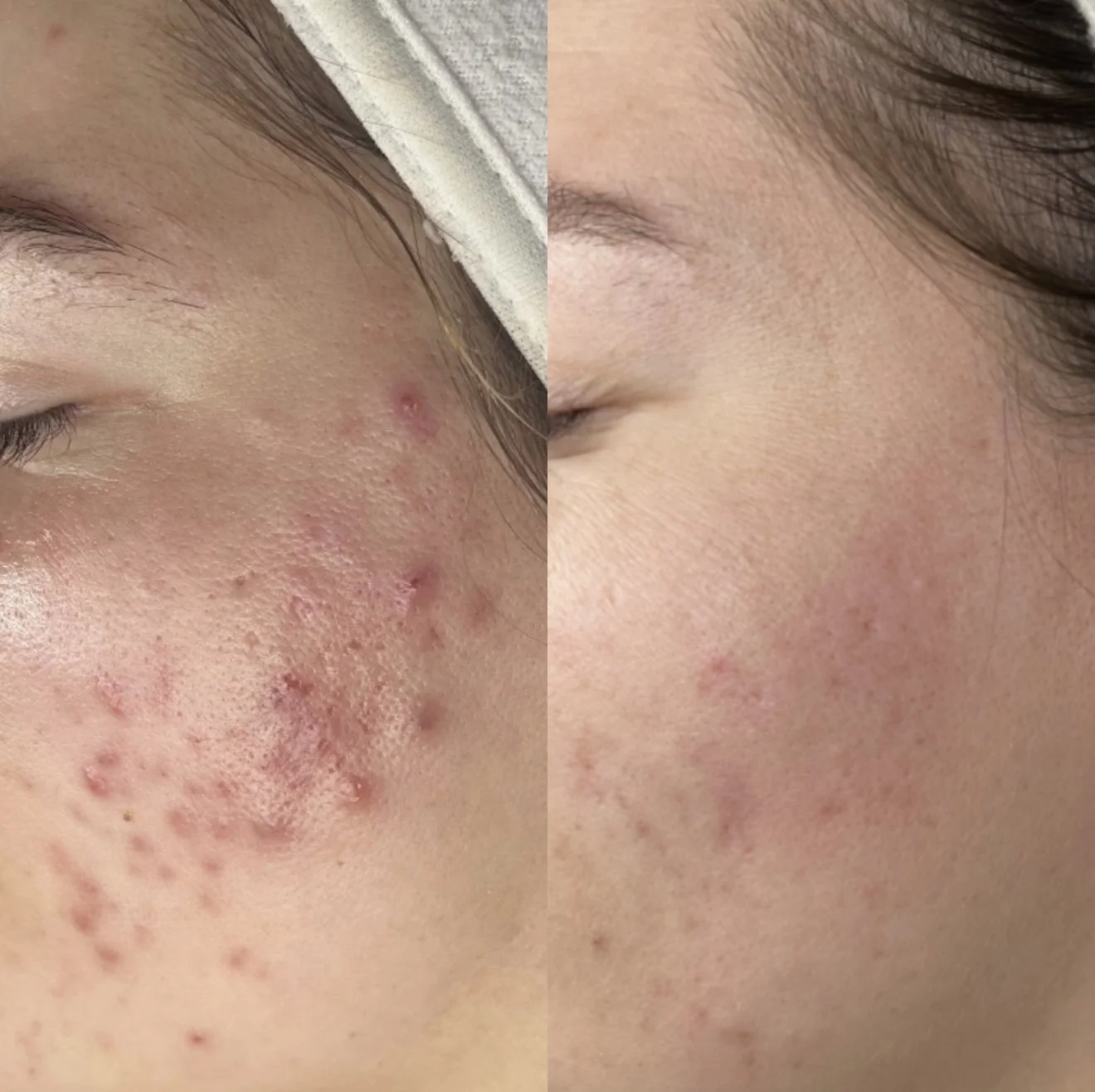 Side-by-side comparison of a person's face with acne before and after skincare treatment.