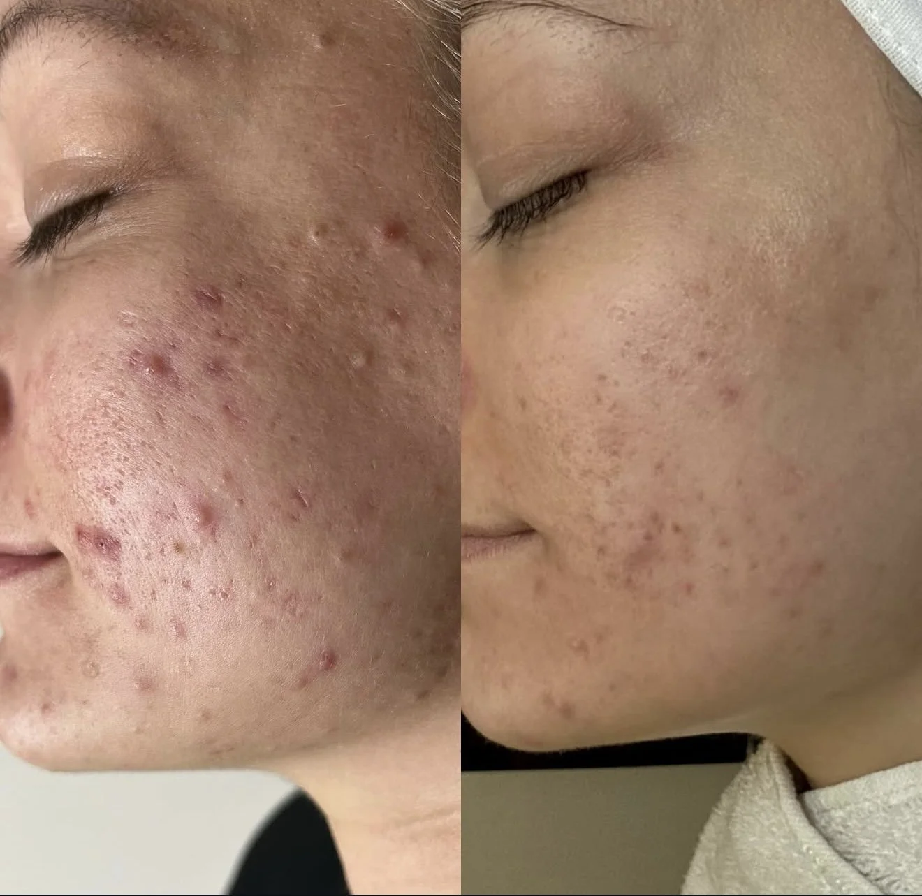 Comparison of a person's face before and after skin treatment, showing reduced acne and smoother skin on the right.