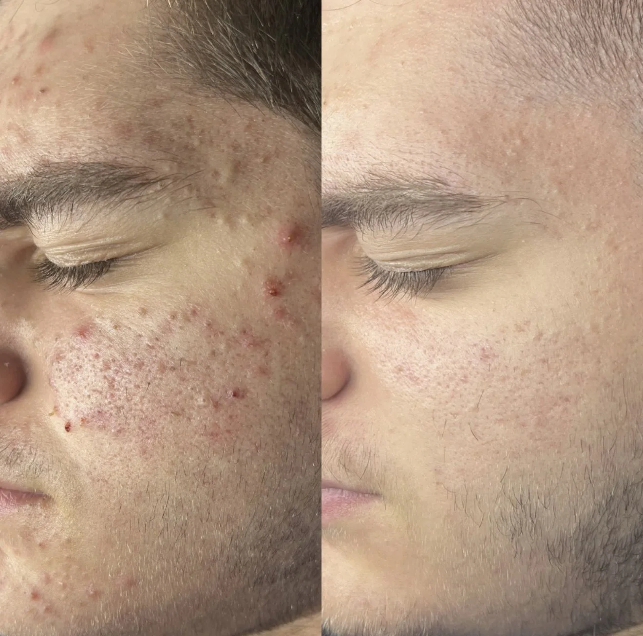 Side-by-side comparison of a person's cheek before and after skin treatment, showing significant reduction in acne and redness.