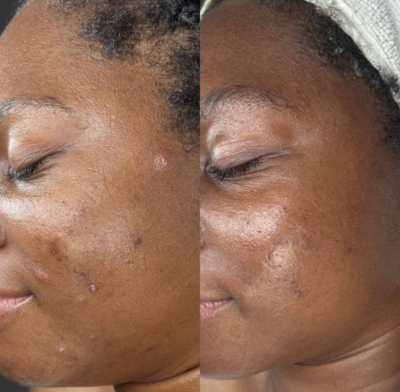 Close-up of a woman's face showing a before-and-after comparison of skin clearing, with visible improvement in acne scars and skin texture.