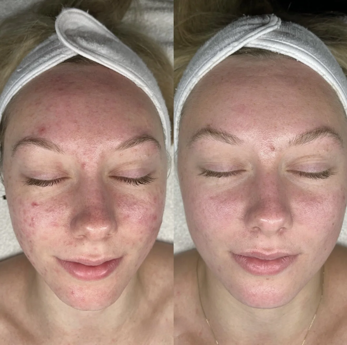Side-by-side comparison of a woman's face before and after skincare treatment, showing clearer skin on the right with reduced redness and blemishes.