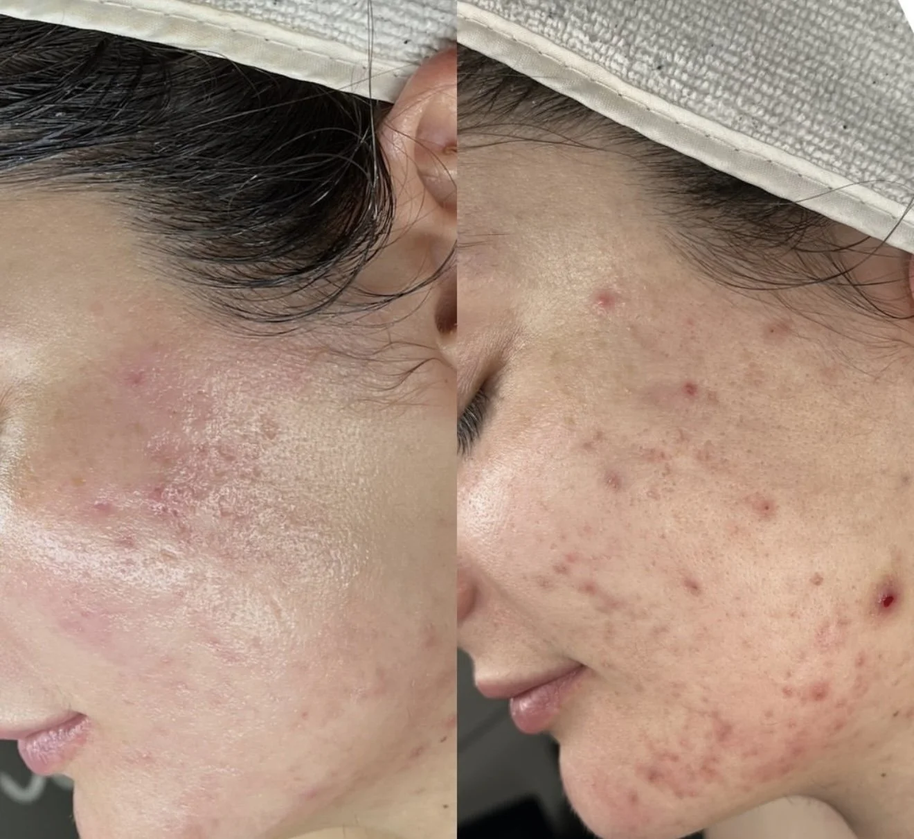 Close-up of a woman's face showing the before and after effects of skincare treatment on acne and skin texture.