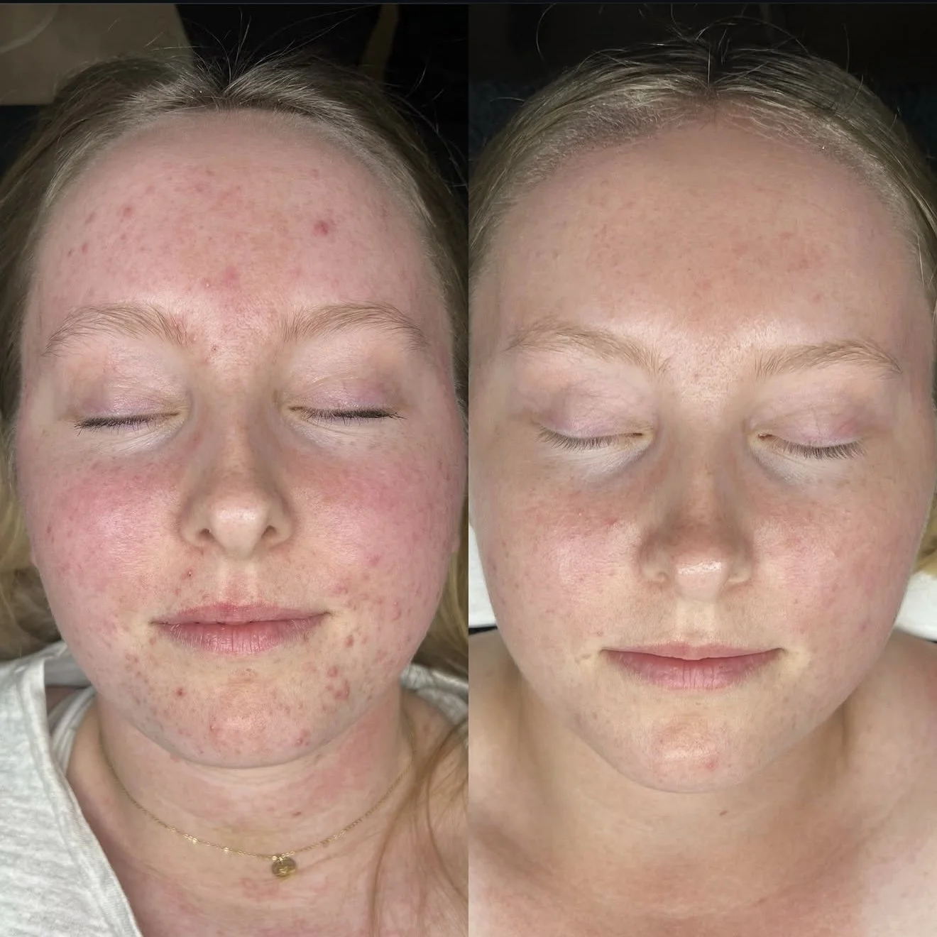 Side-by-side comparison of a woman's face showing improvement in skin condition, with acne and redness on the left and clearer skin on the right.