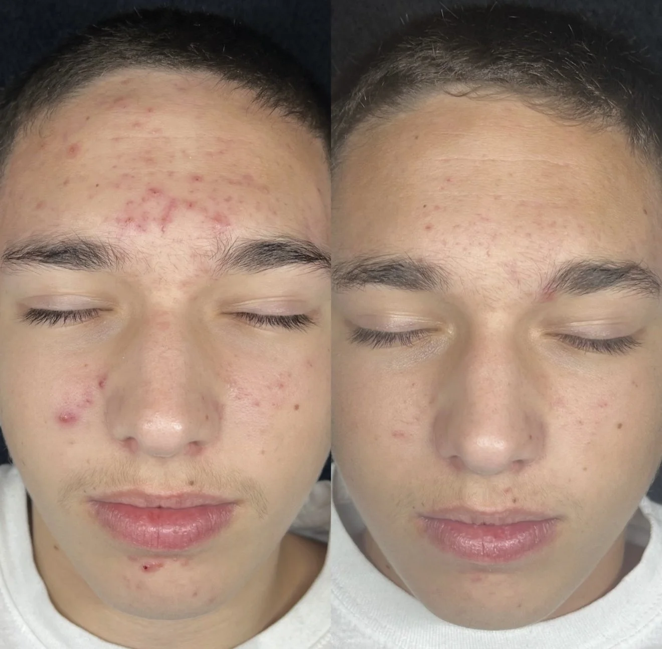 Side-by-side photos of a person's face showing improvement of acne and skin condition.