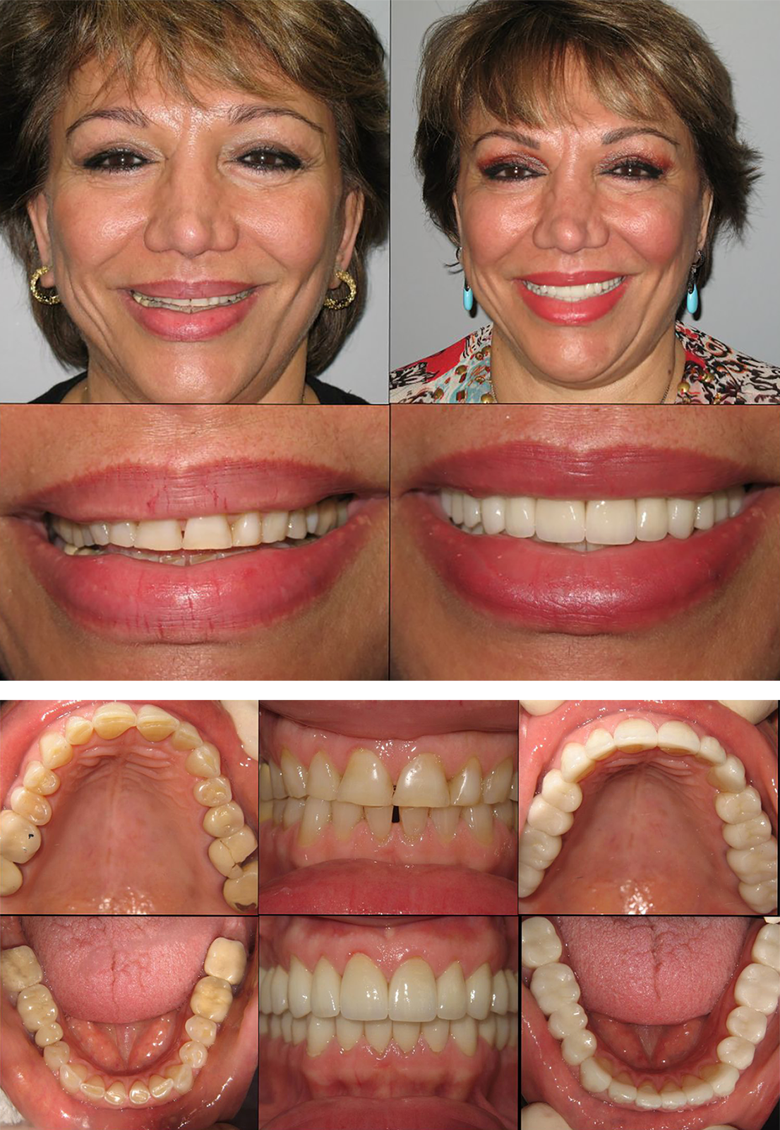 Smile-Rejuvenation-collage-2.png