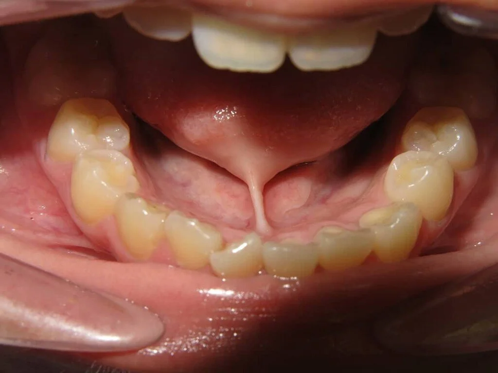 Tip of the Tongue Tie