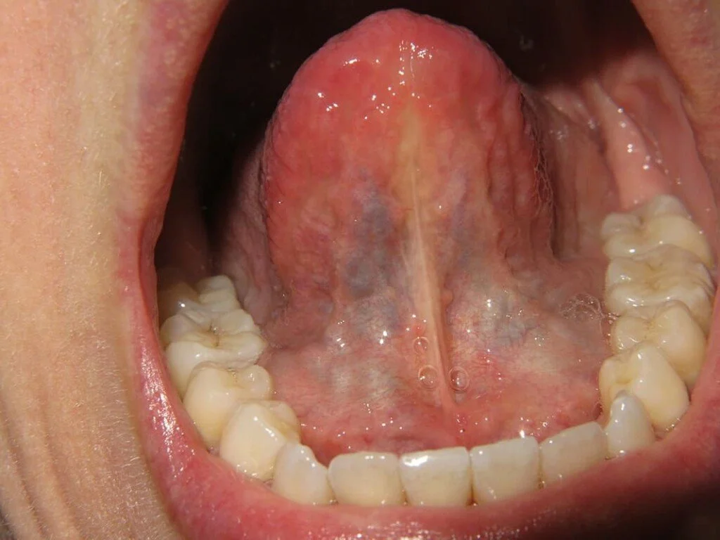 Anterior Tongue Tie