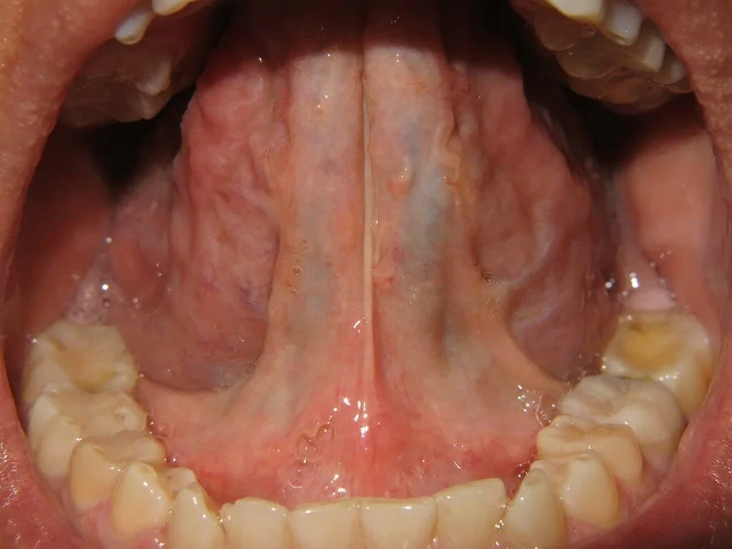 Posterior Tongue Tie