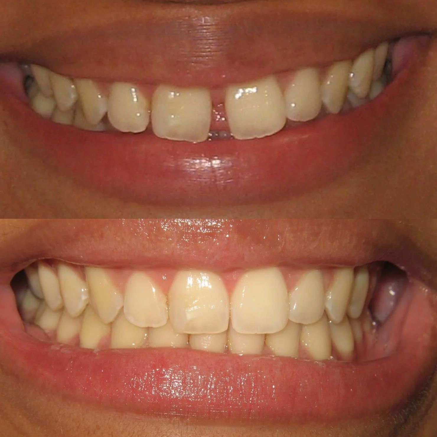 invisalign-beforeafter-1.jpg