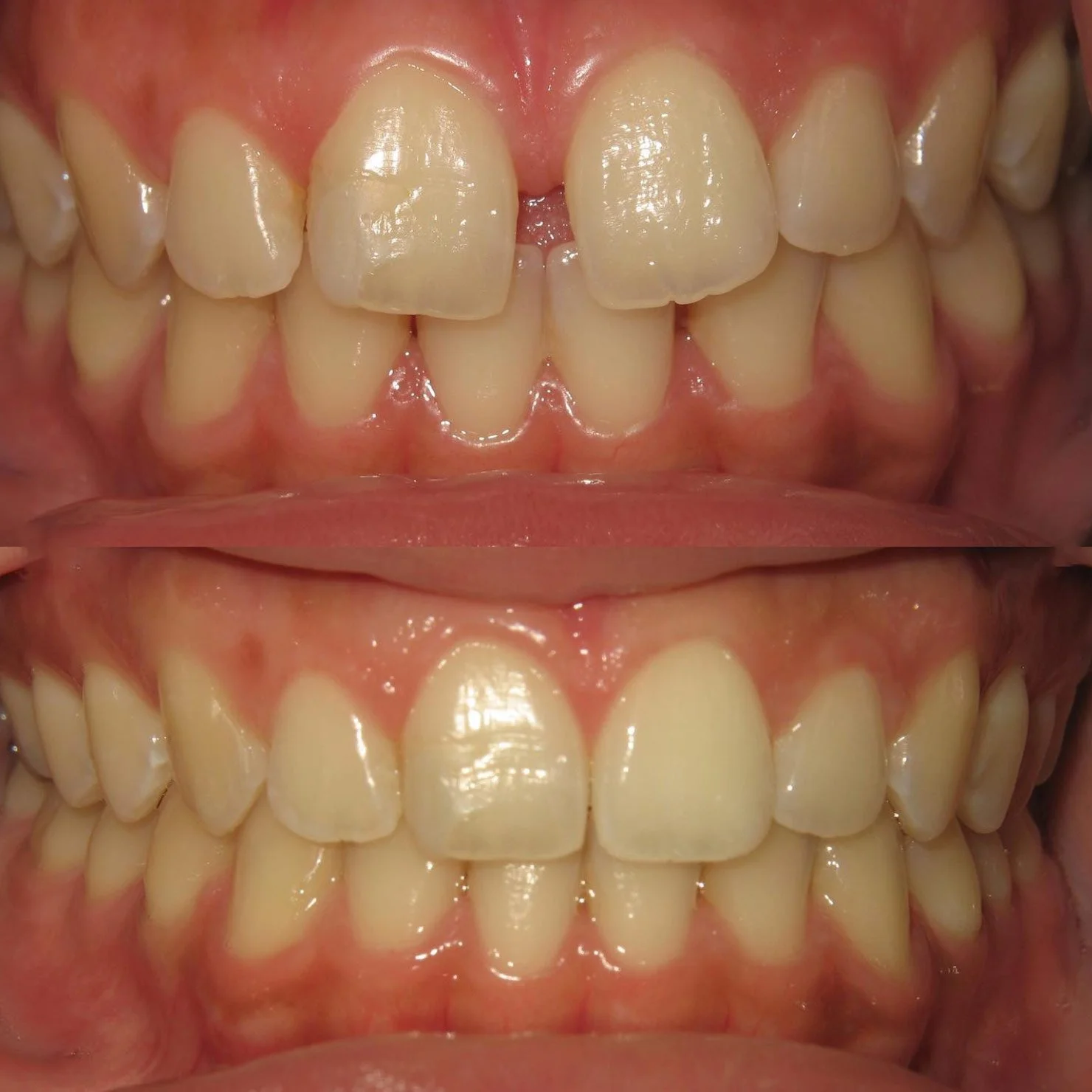 invisalign-beforeafter-2.jpg