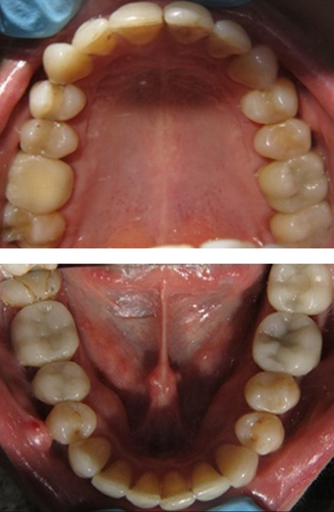 Normal Upper &amp; Lower Arch