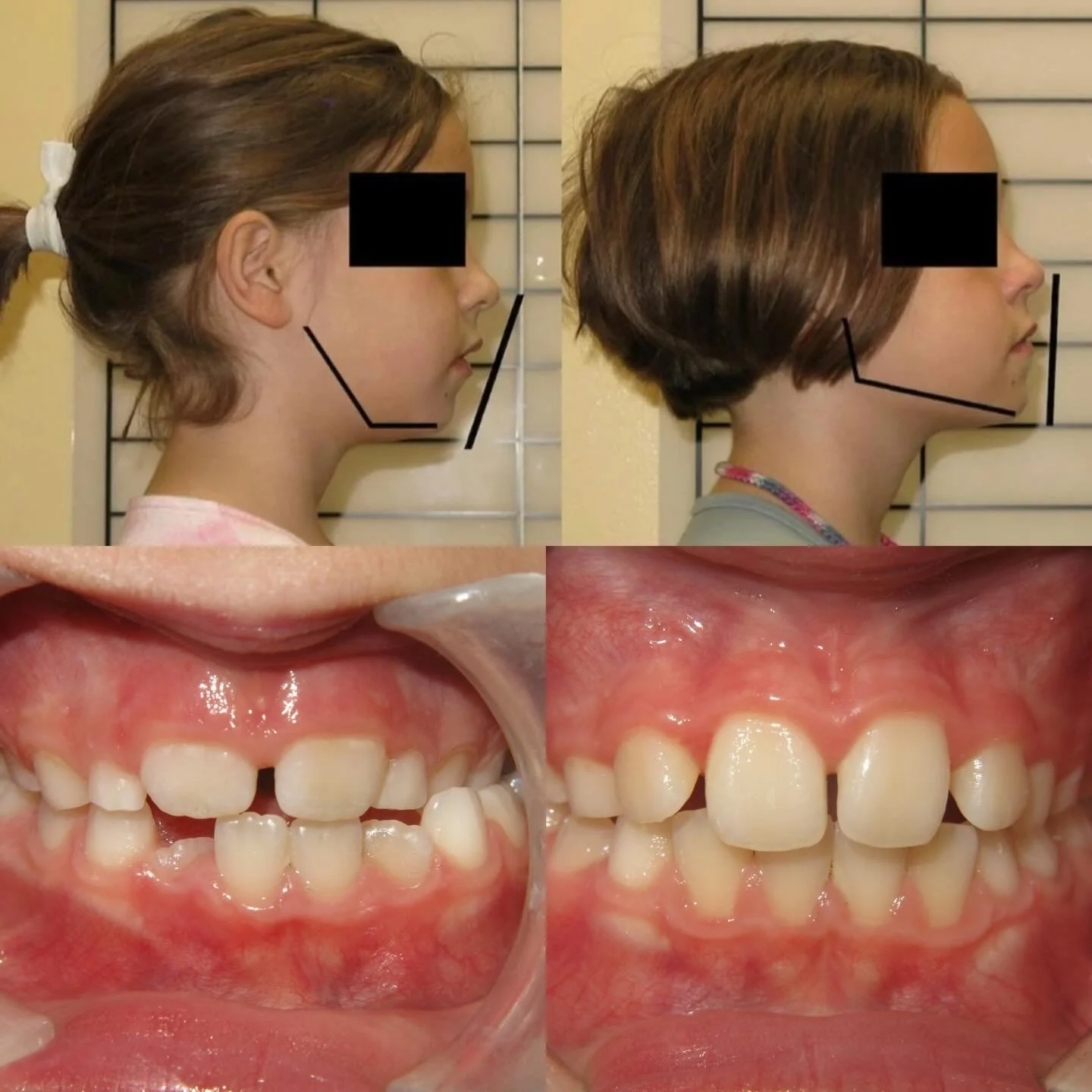 Most parents don&rsquo;t realize how much their child&rsquo;s airway affects their face, behavior, and development. 🤯

When this young patient came to us, her parents were focused on her teeth but we saw something deeper. Her airway, her oral postur