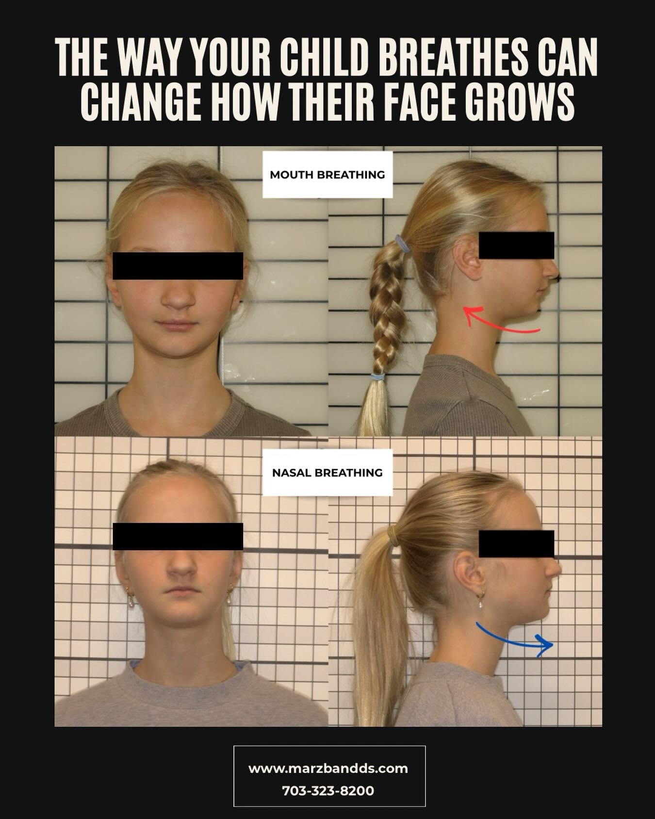 Mouth breathing isn&rsquo;t just a habit, it can affect:

&bull; Facial growth
&bull; Jaw development
&bull; Airway size
&bull; Sleep quality

This patient shifted from mouth breathing to nasal breathing through:

✔️ Functional therapy
✔️ Appliance t