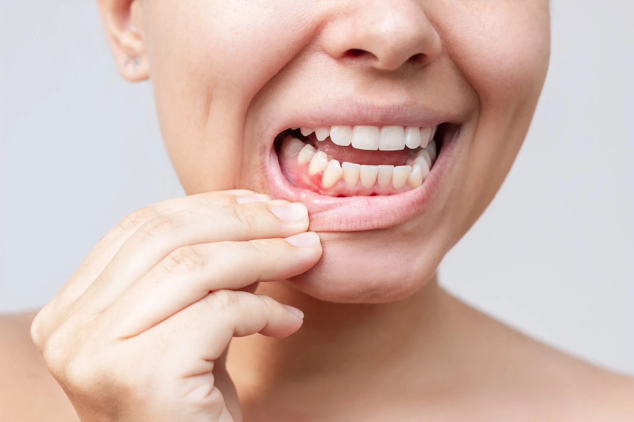 What Are the Symptoms of Gum Disease?