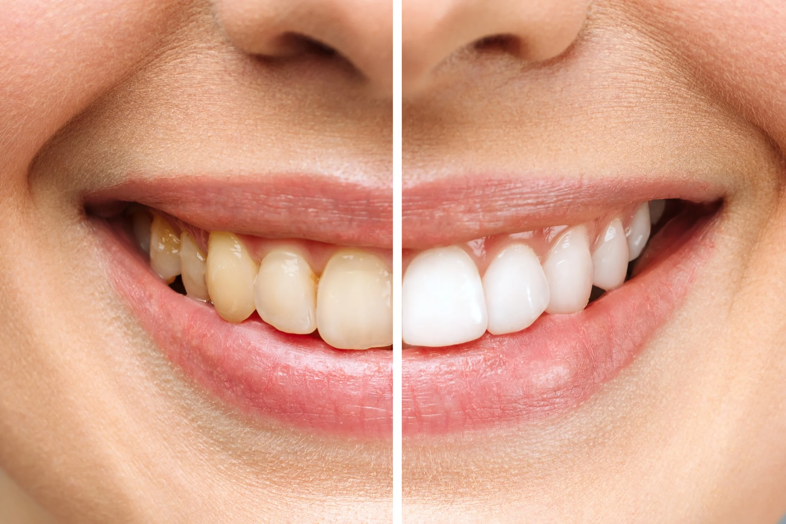 What is the Most Popular Cosmetic Dental Procedure?