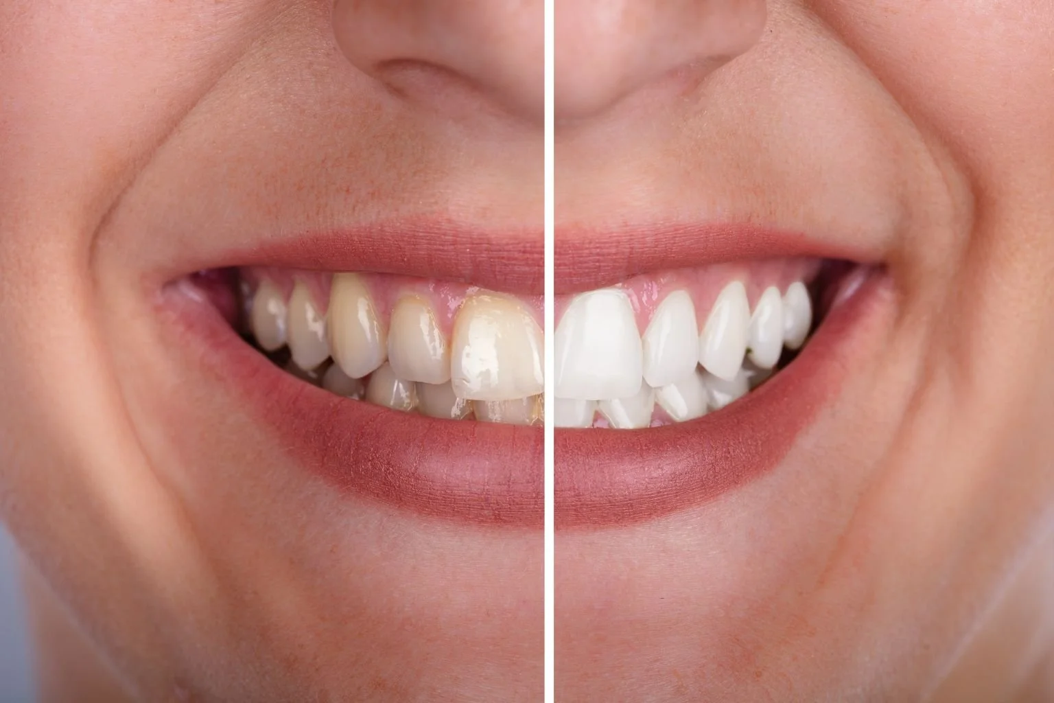 What is Teeth Bonding?