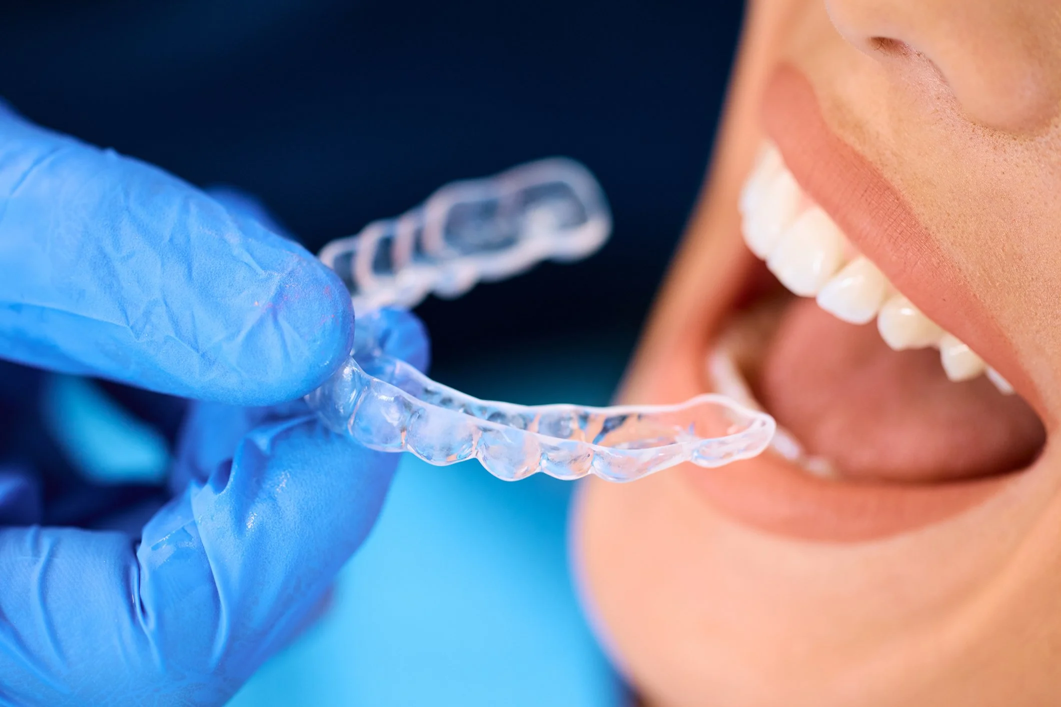 What Are the Most Effective Oral Appliances for Sleep Apnea?