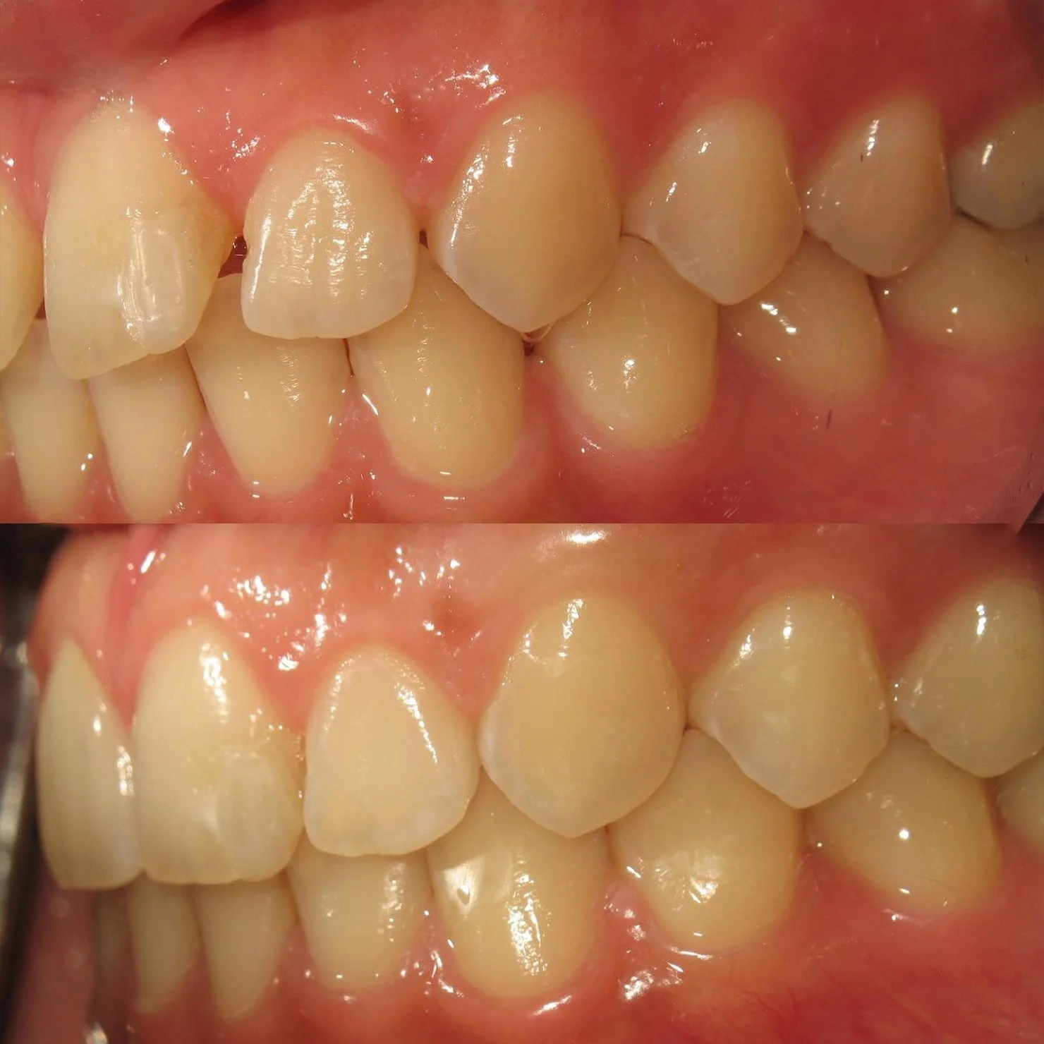 invisalign-beforeafter-4.jpg