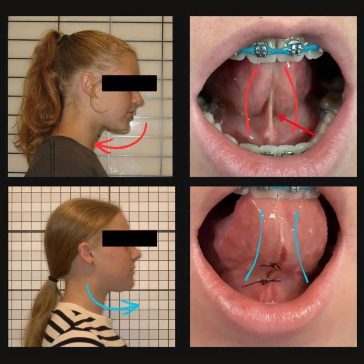 Tongue Release Expansion 