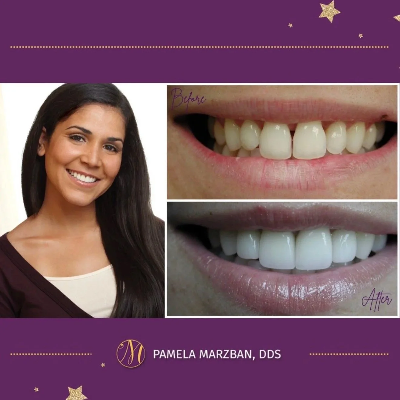 Dental Porcelain Veneers, Burke VA Dentist