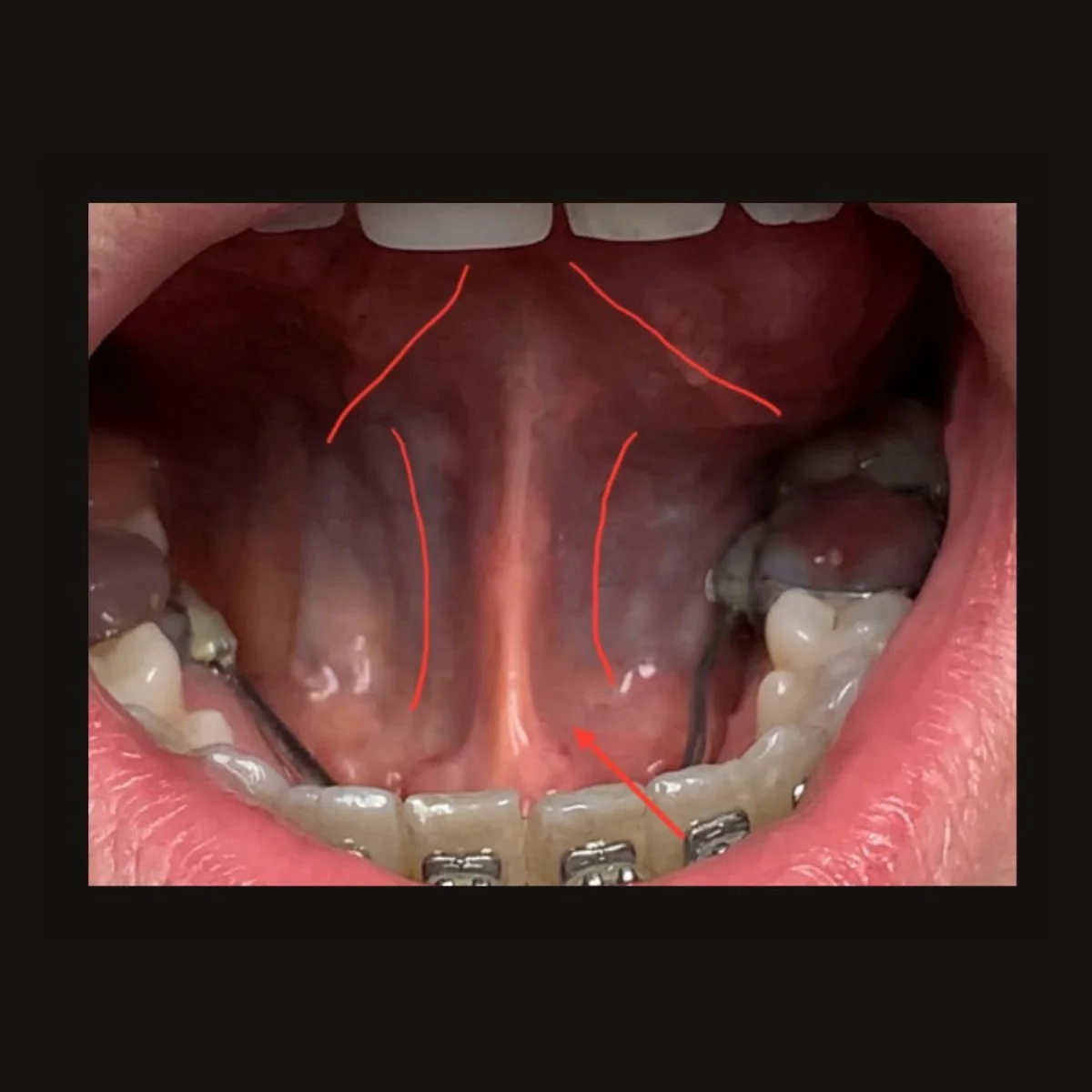  Tongue Release 