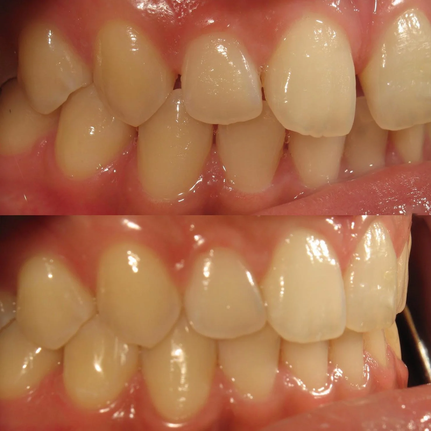 invisalign-beforeafter-3.jpg
