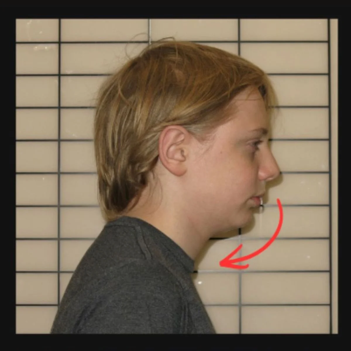  Sagittal Expansion 