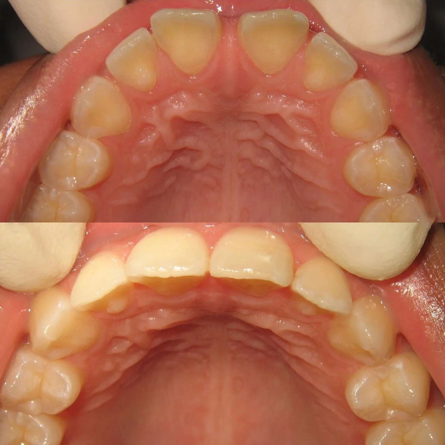 invisalign-beforeafter-5.jpg