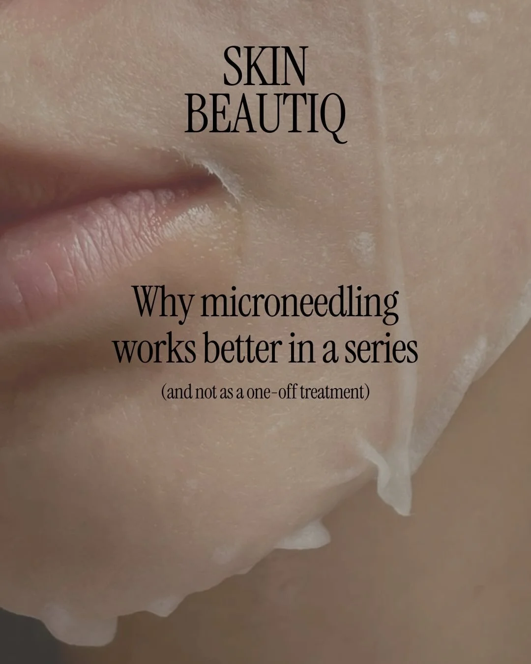 Microneedling isn&rsquo;t about a quick fix - it&rsquo;s about training your skin to rebuild stronger over time.

Each session stimulates collagen, but real transformation happens when treatments are properly spaced and done in a series. Think struct