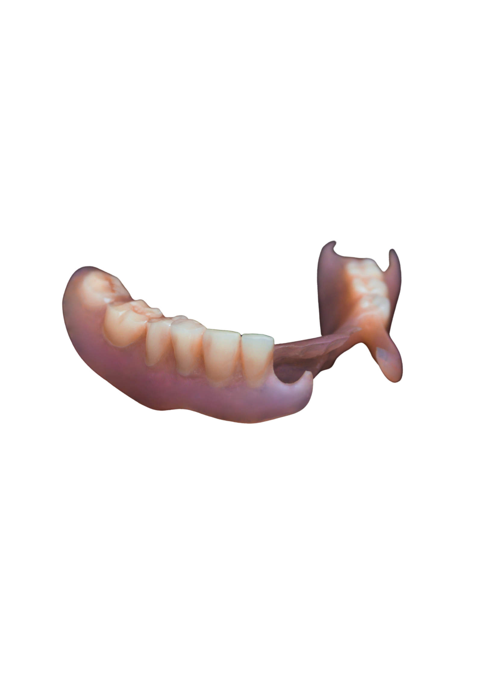 Flexible Partial Dentures