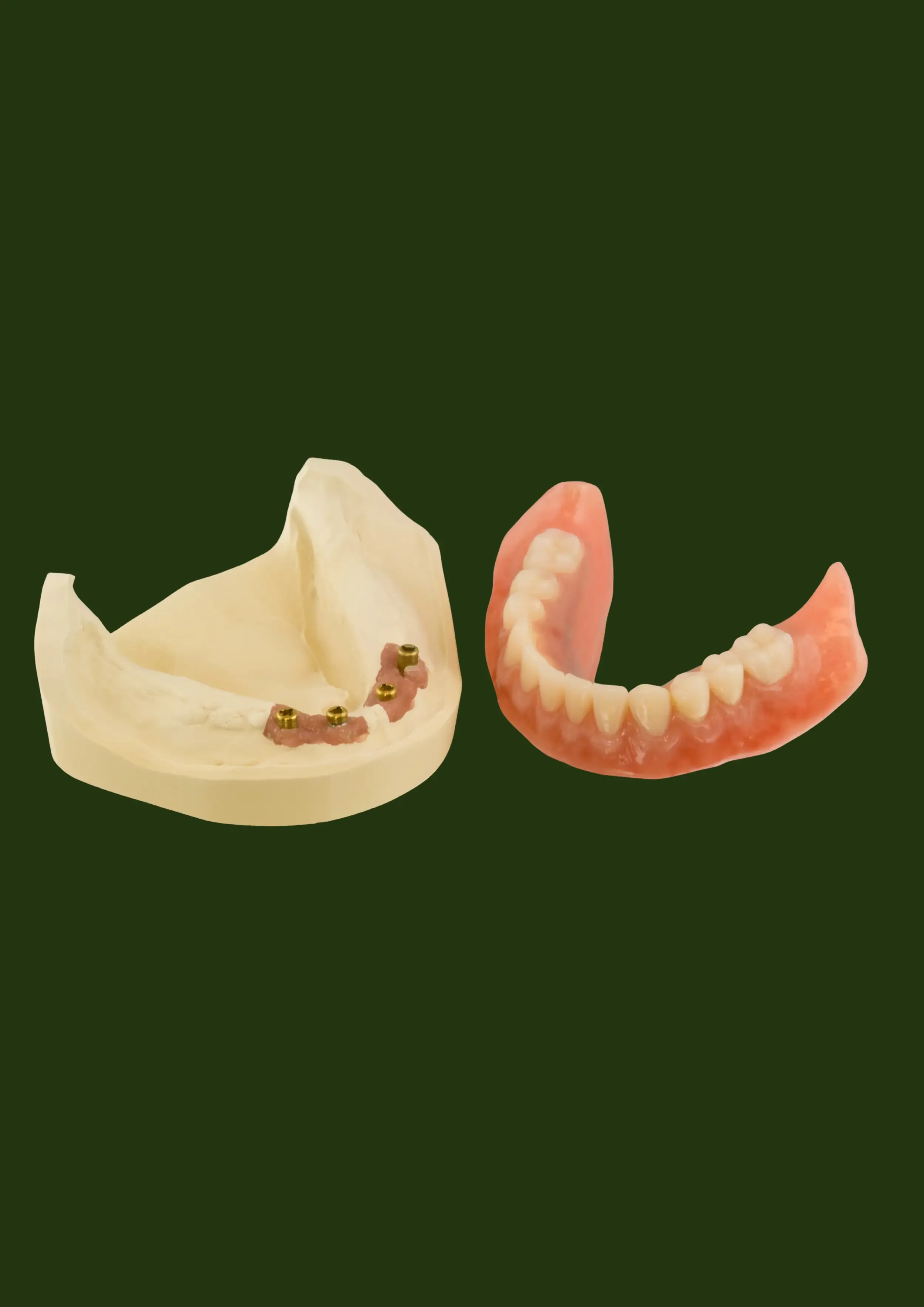 Implant-supported overdenture model showing attachment points — Prestige Dentures Auckland