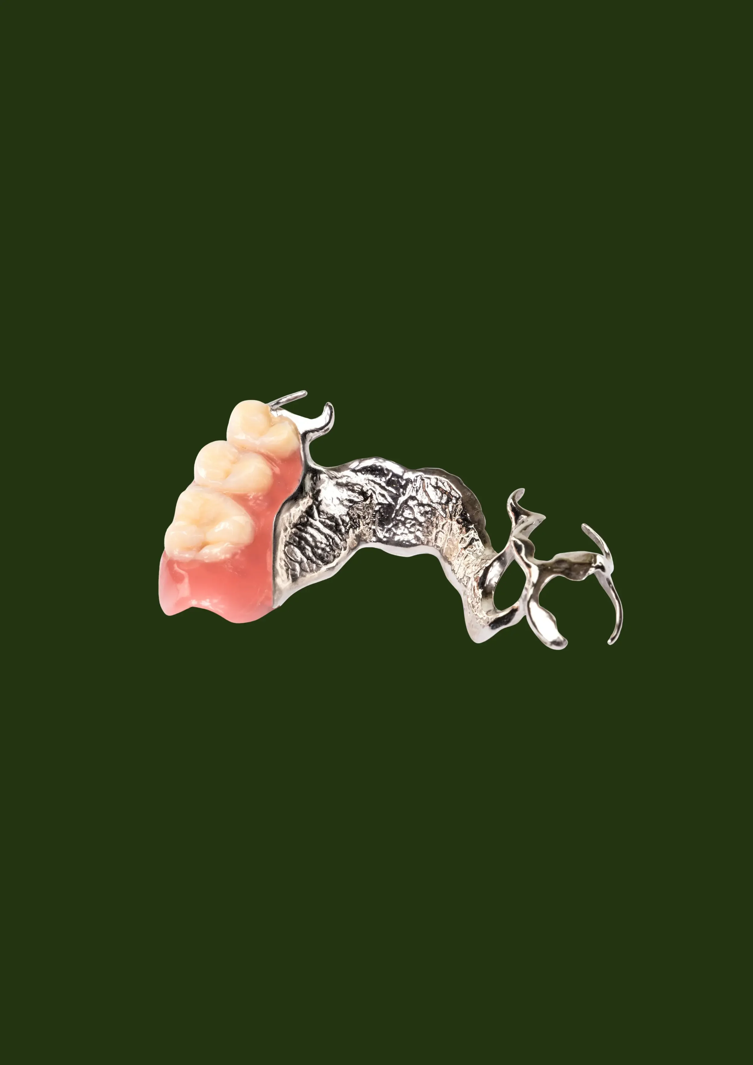 Chrome cobalt metal partial denture framework — Prestige Dentures Auckland