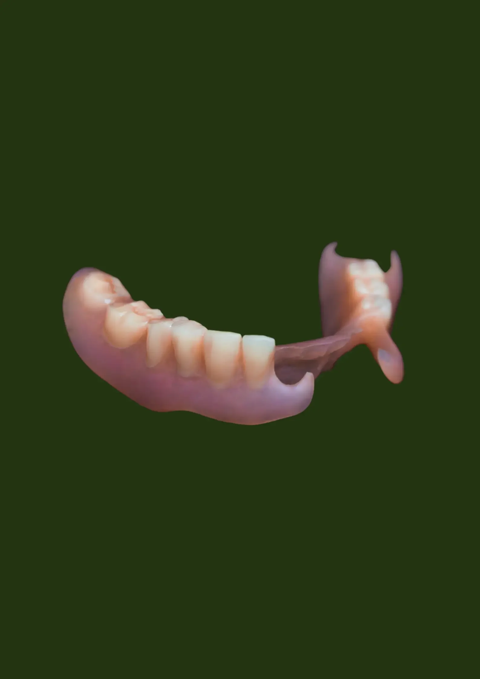 Flexible Valplast partial denture with no metal clasps — Prestige Dentures Auckland