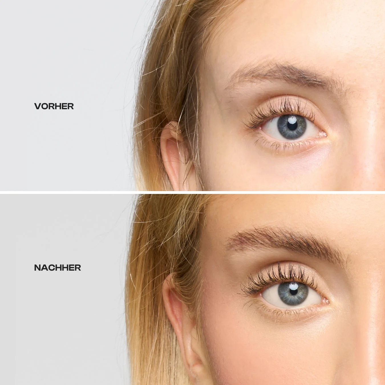 Comparison of a woman's eye area before and after cosmetic treatment; top image labeled 'VORHER' (before), bottom image labeled 'NACHHER' (after).