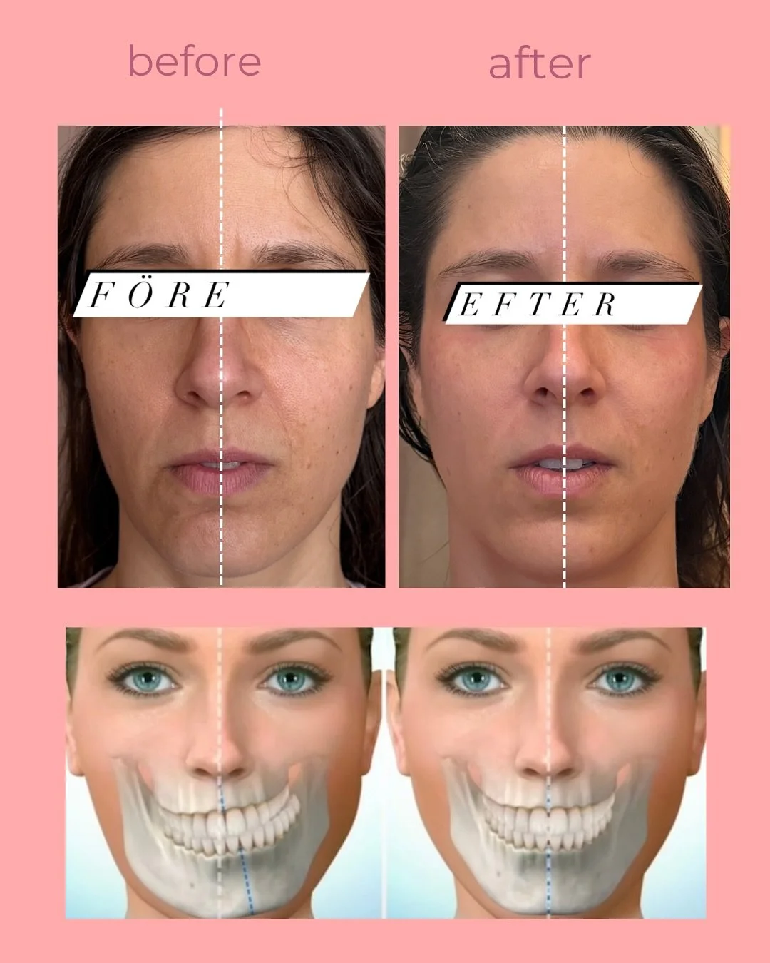 Sculpt Buccal Gua Sha✨#result🔥
#feminabellaest 
#buccalmassage #intraoralmassage #ansiktsmassage #facialmassage #faceyoga #lymphaticdrainage #glowingskin #naturalfaceuplift #facialcontouring #masseterrelease #holisticbeauty #facialsculpting #skincar