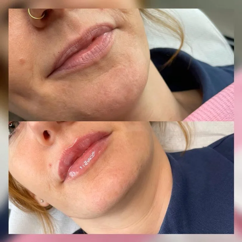 Lip Enhancement
