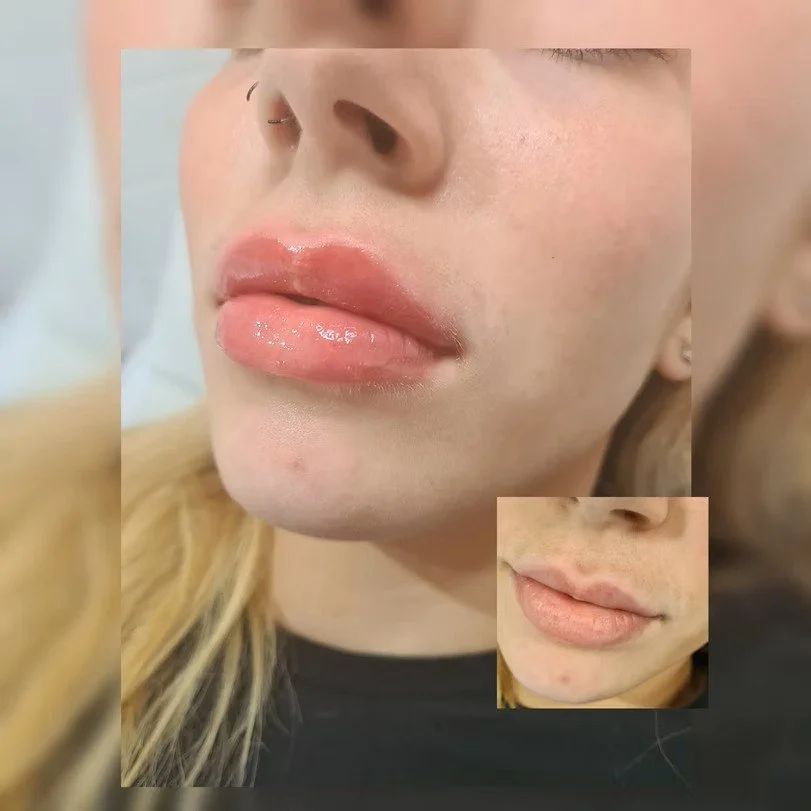 Lip Enhancement