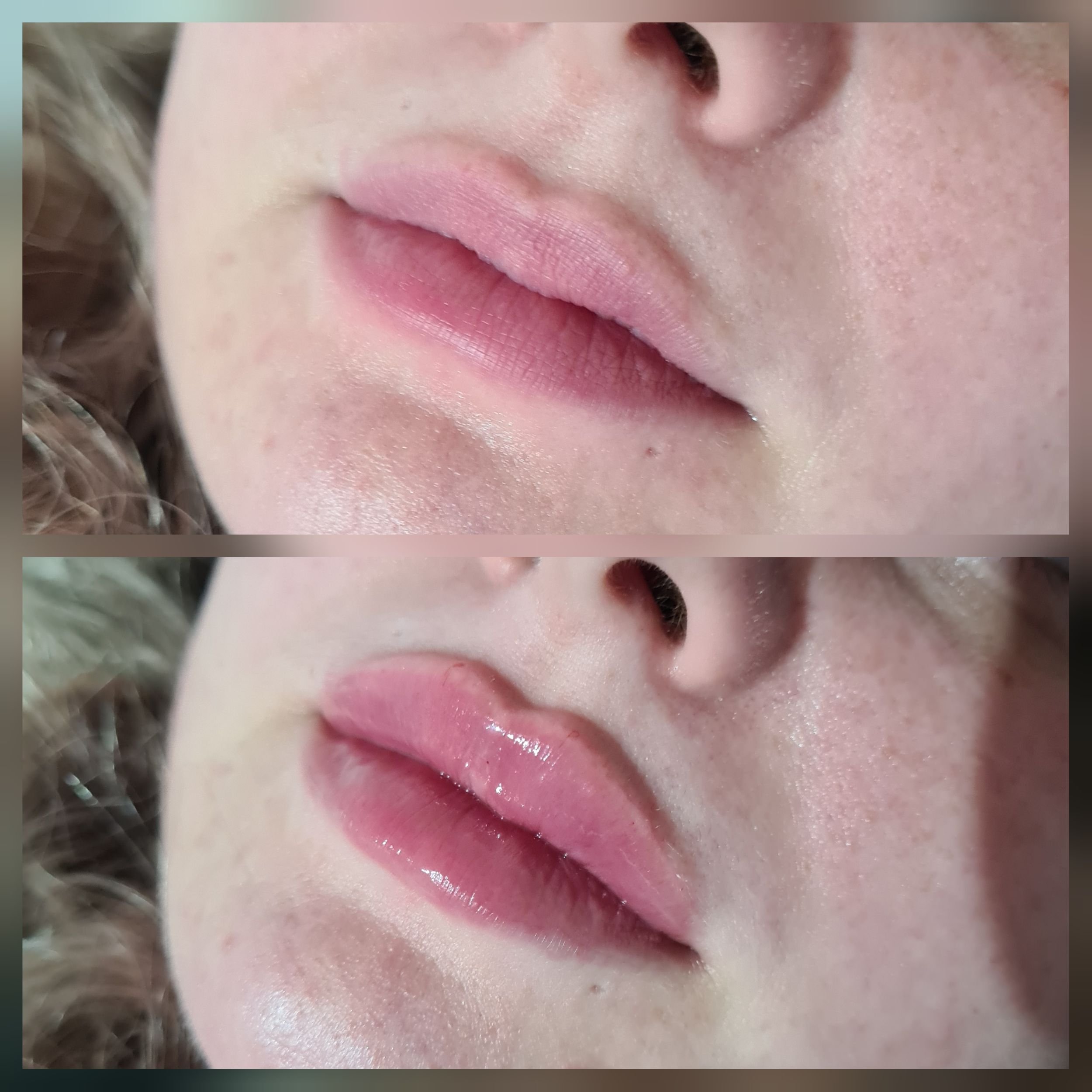Dermal Lip Filler 1.jpg
