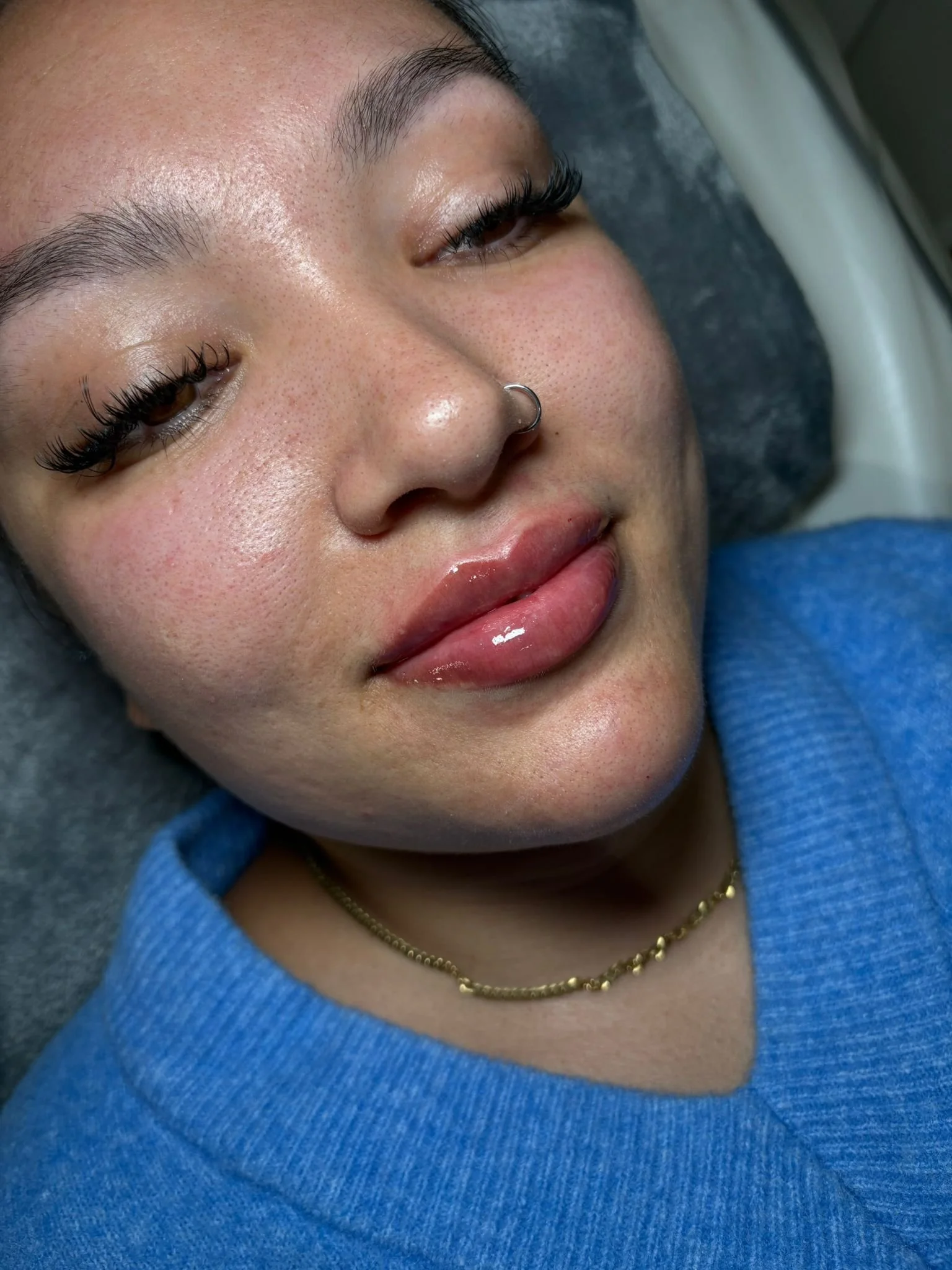 Dermal Lip Filler 5.jpg