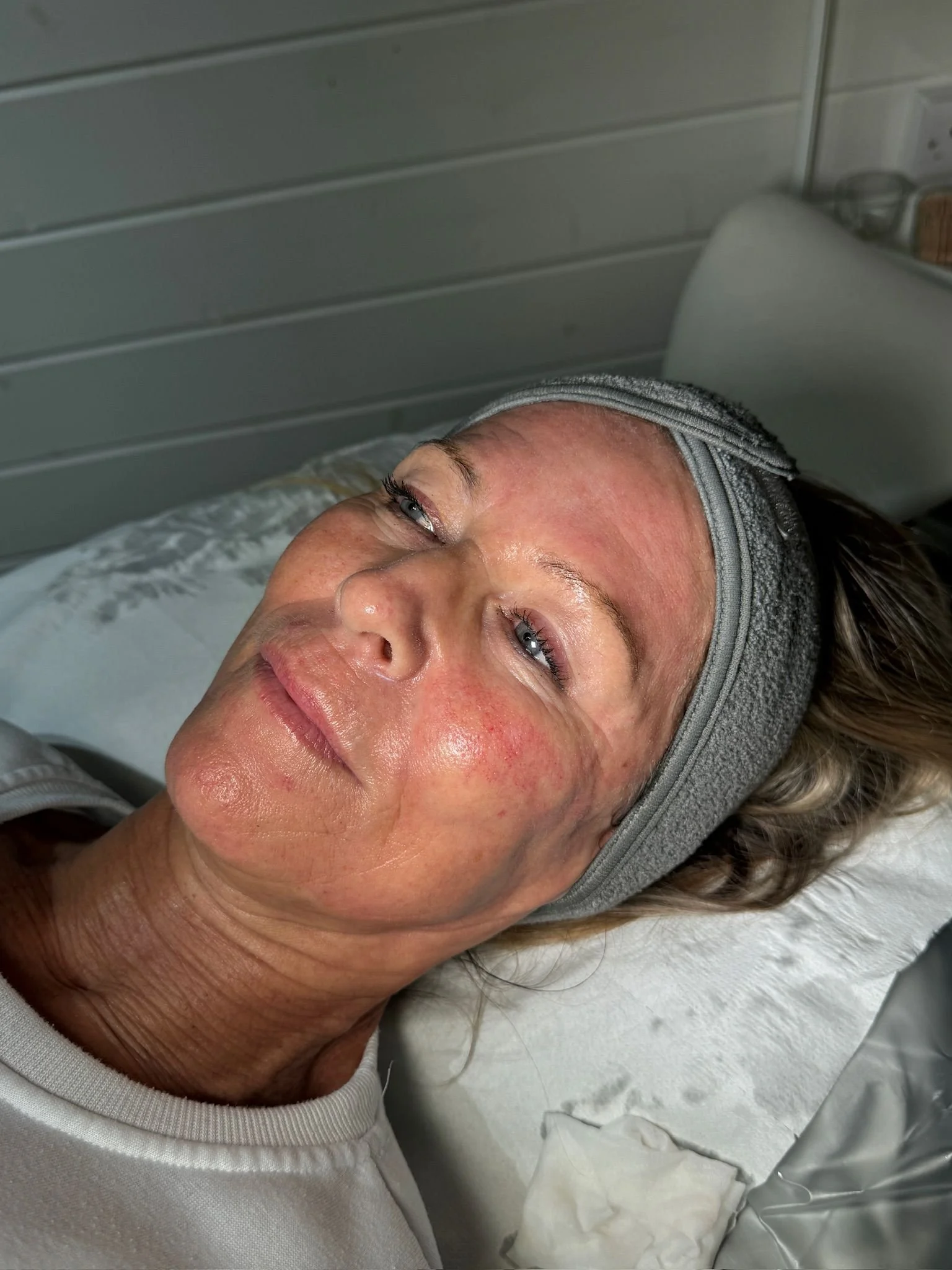 Glass Skin Facial (Anti-Wrinkle Treatment and Mirconeedling).jpg