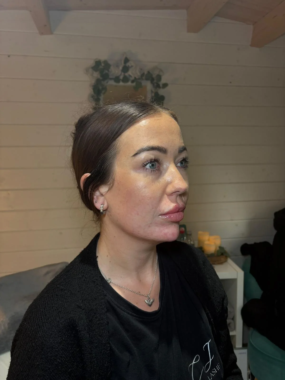 Facial Balance Package (Chin and Lips).jpg