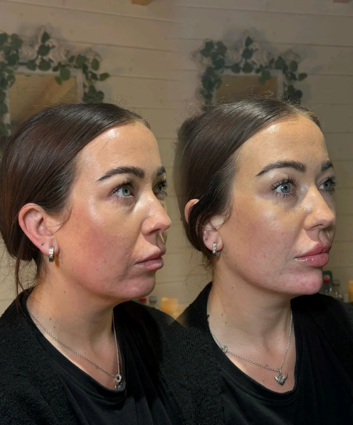 Facial Balance Package (Chin and Lips Filler)_.jpg