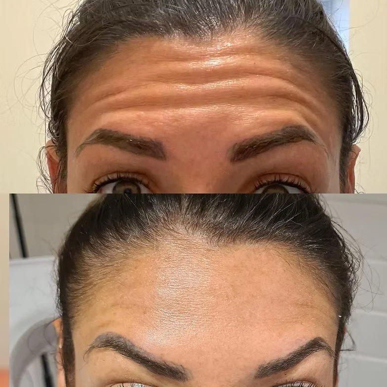 Anti-Wrinkle Forehead