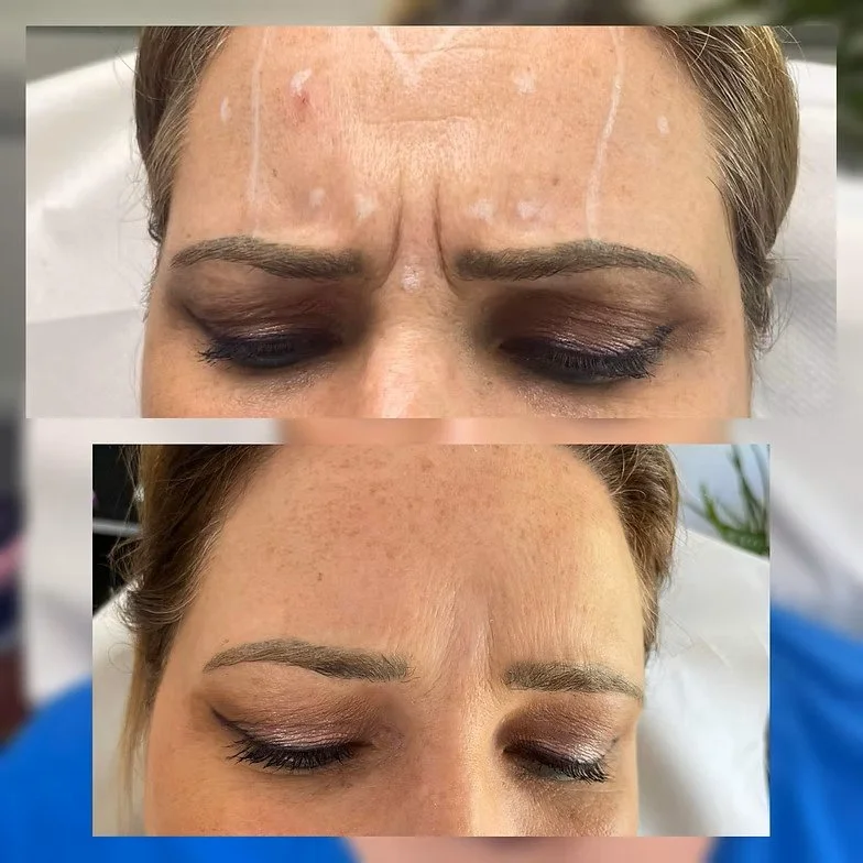 Glabella Before &amp; After