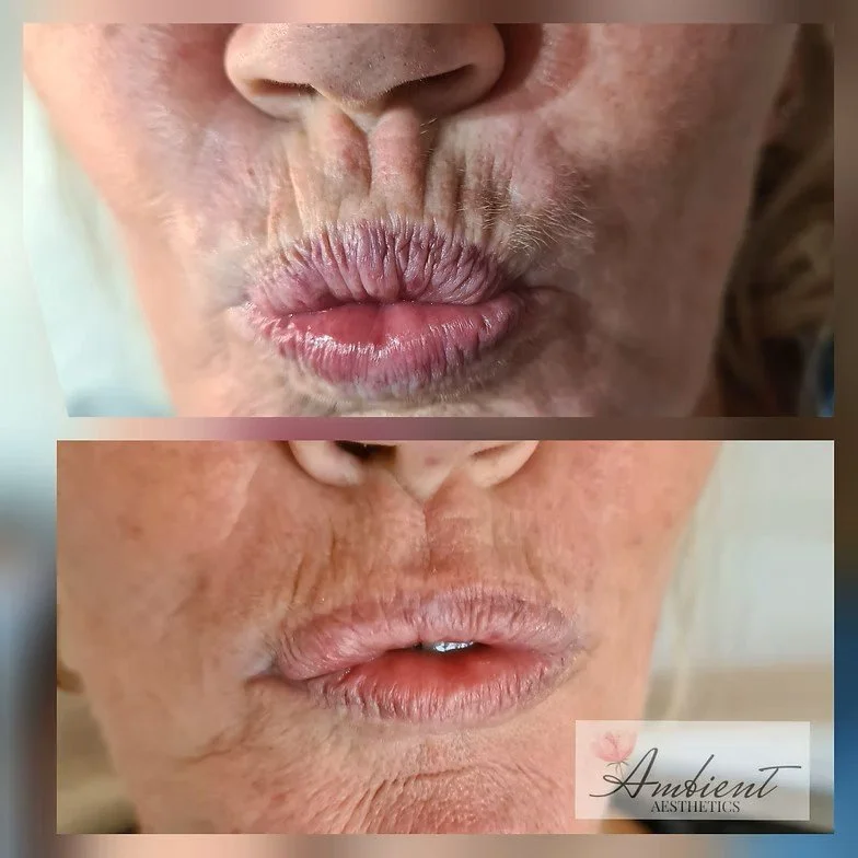 Anti-Wrinkle Smokers Lines