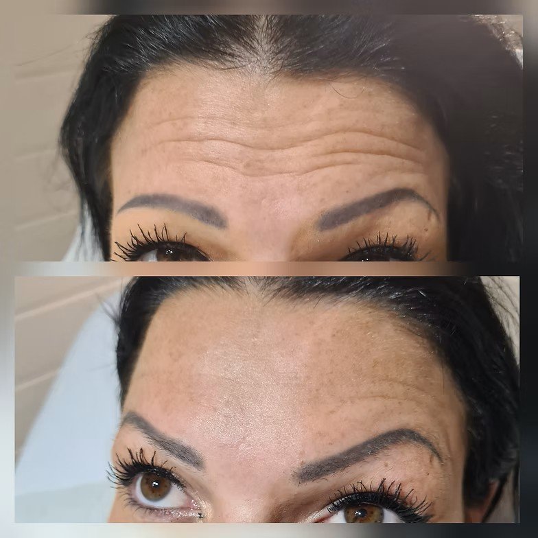 Anti-Wrinkle Forehead