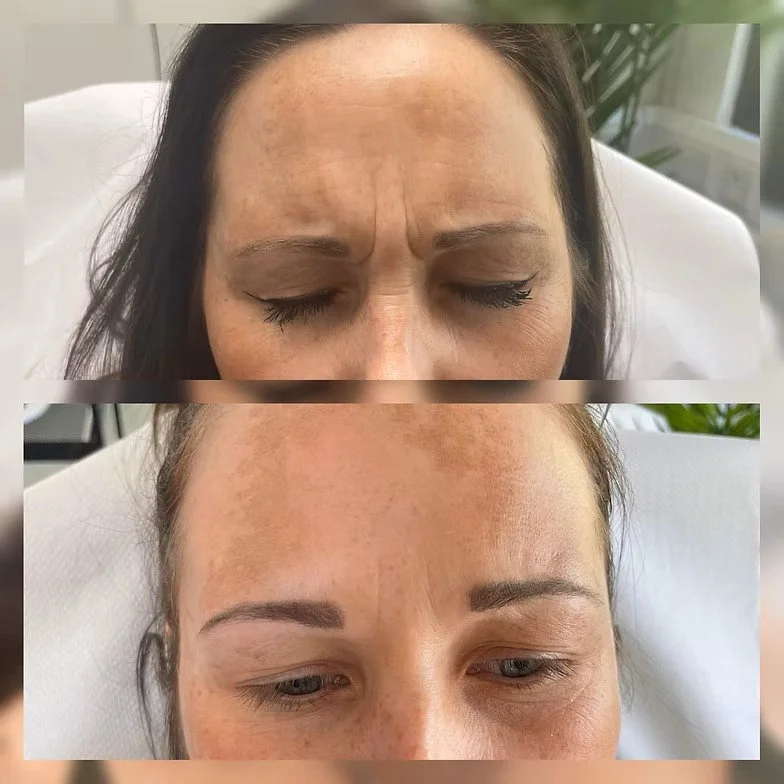 Glabella Before &amp; After