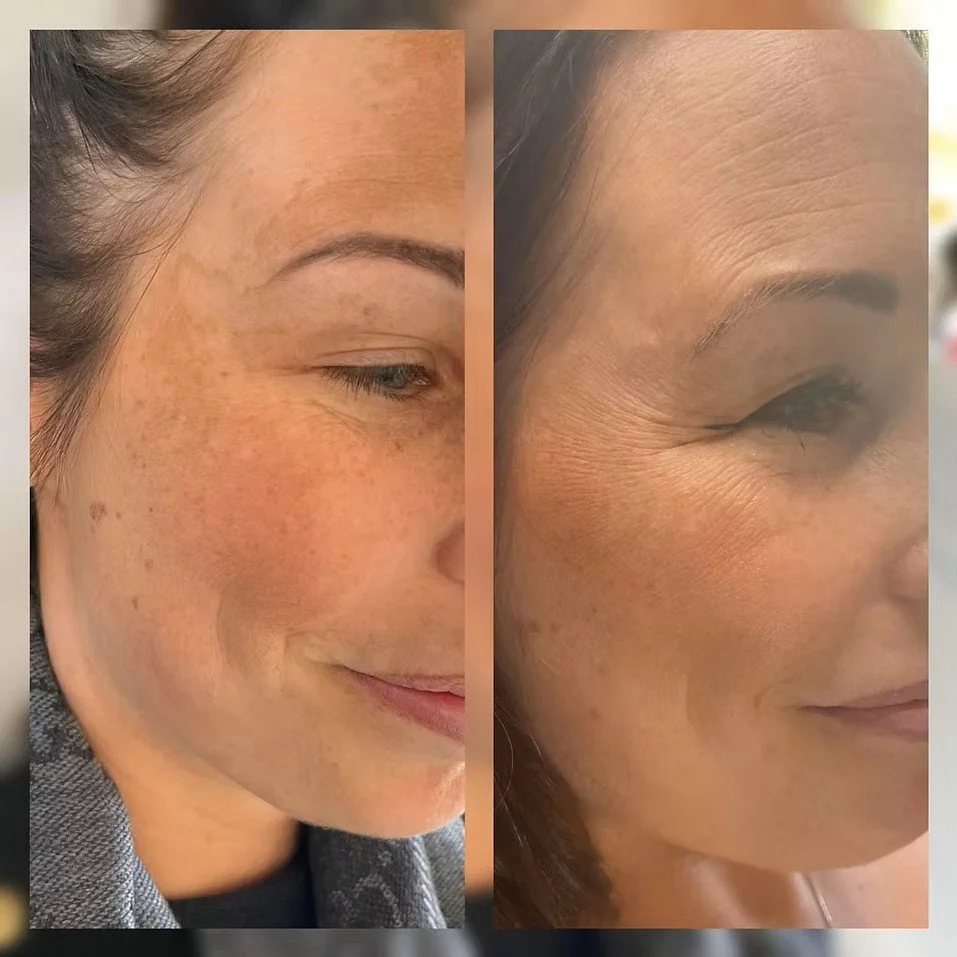 Crows Feet Before &amp; After